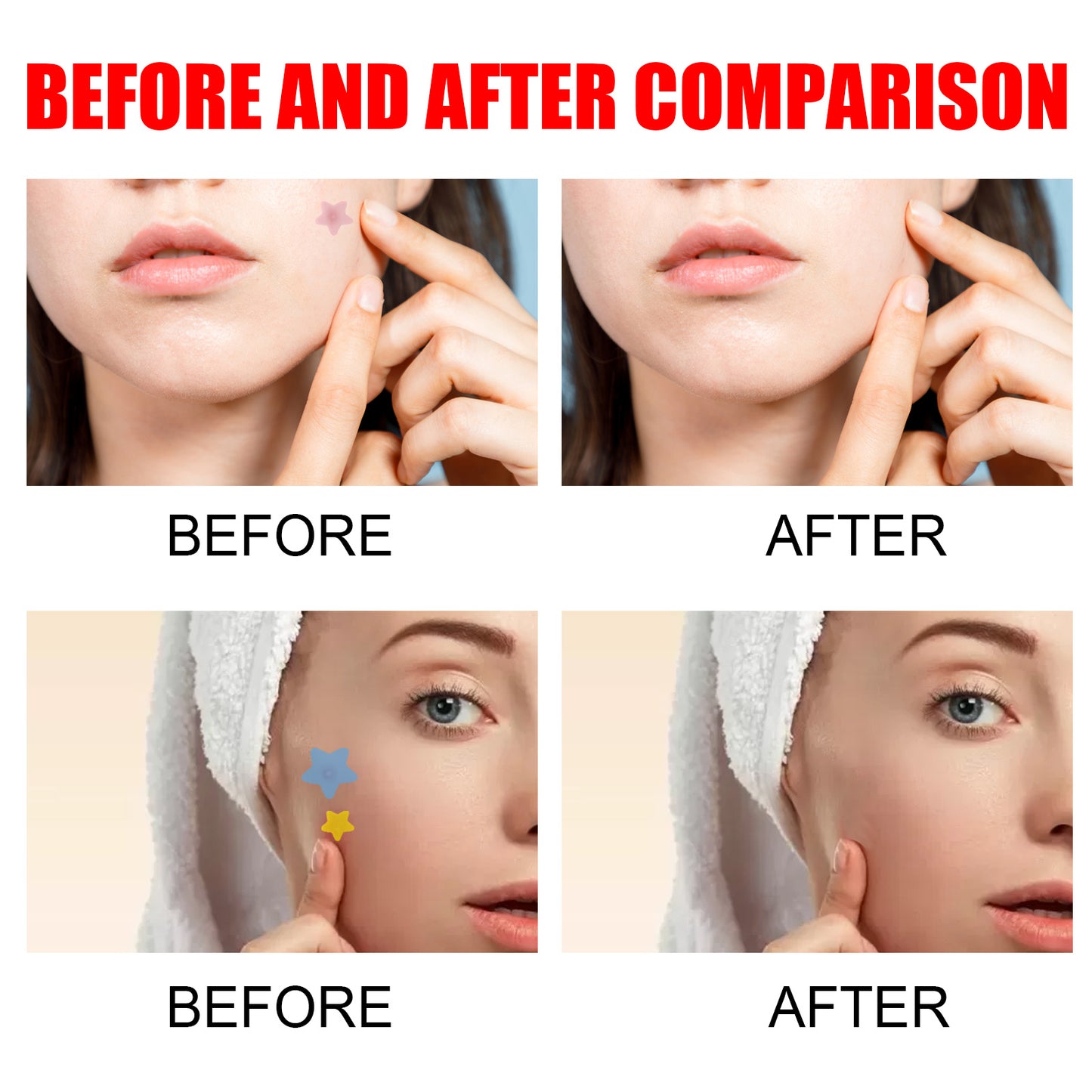 Cute Star Pimple Patches – Hydrocolloid Acne Stickers for Face, Zits & Blemish Cover